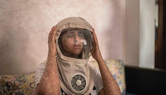 Девушка с редким диагнозом 20 лет живет по ночам и выходит под солнце только в скафандре