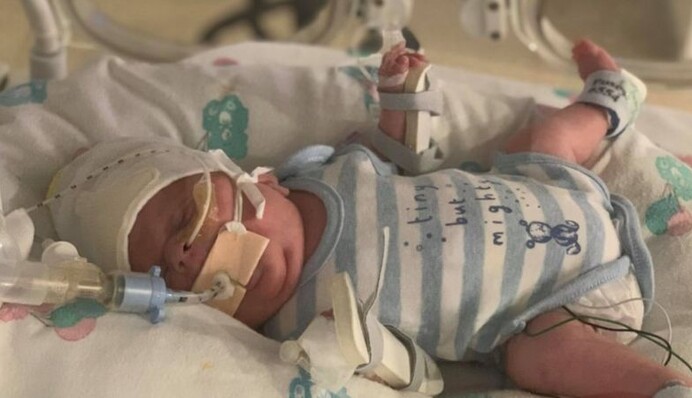 Немовля дивом вижило після коронавірусу та інших небезпечних хвороб - важило менше 800 грам: фото
