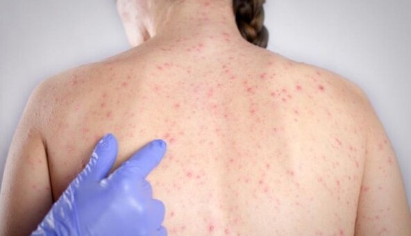 Это просто фильм ужасов: инфекционист о ситуации в Украине с высокозаразной болезнью