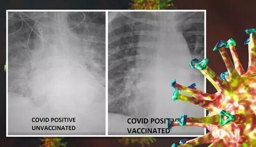 Как выглядят на рентген-снимках легкие привитого и непривитого пациентов с COVID-19