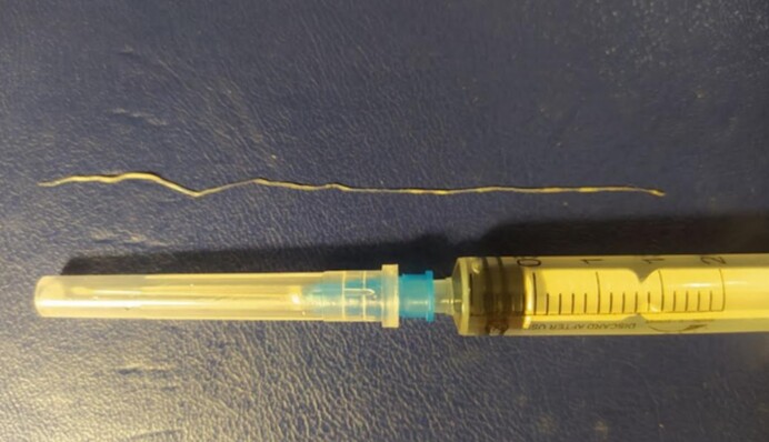 У украинки в веке нашли огромного живого паразита: фото и видео