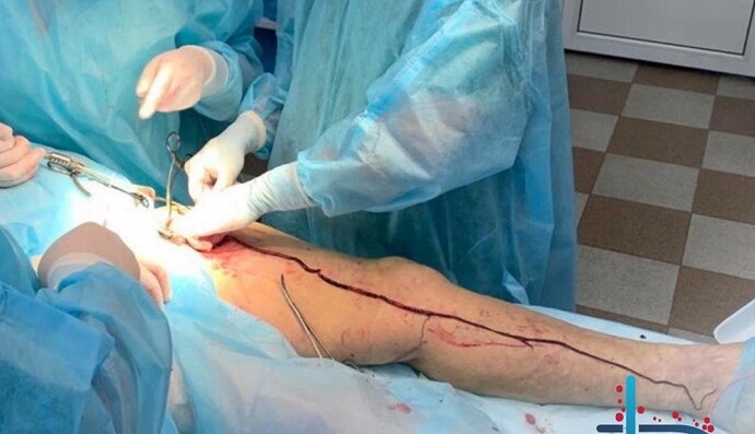 В українки, яка перехворіла на COVID-19, видалили гігантський тромб: медики показали фото