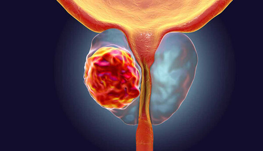 Розвиток раку у чоловіків: лікар назвав головні симптоми та способи уникнути хвороби