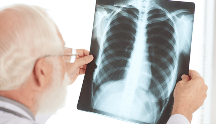 Пневмонія після COVID-19: лікар назвав симптоми та розповів, що робити