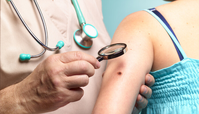 Что будет, если повредить родинку: онколог развеяла популярный миф