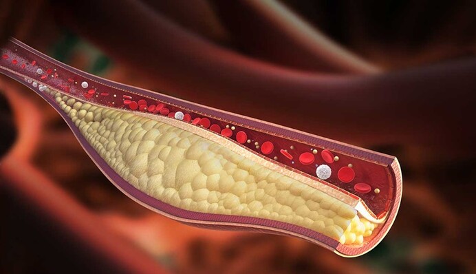 Как определить высокий холестерин: медики назвали простой способ