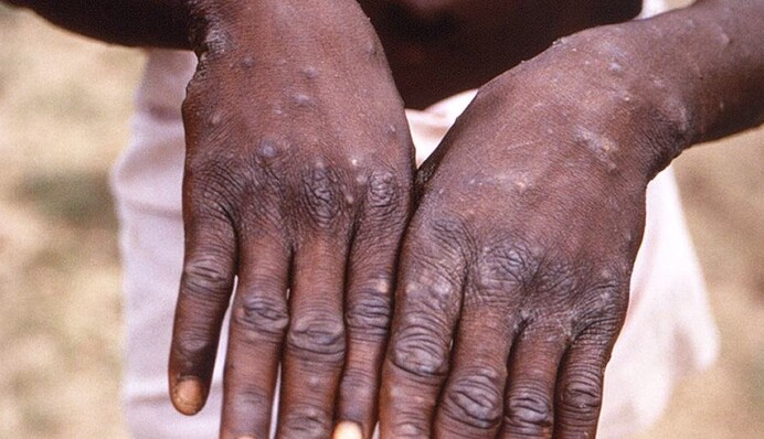 Віспа мавп поширюється світом: як готуються в Україні до можливих заражень