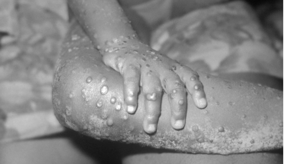 Обезьянья оспа продолжает атаковать Европу: список стран и первые симптомы болезни