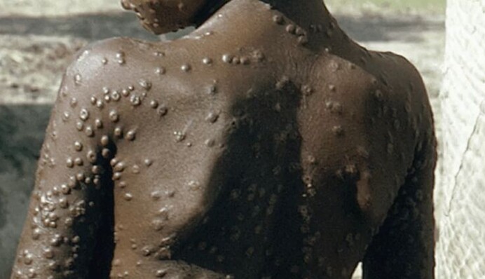 За вспышкой обезьяньей оспы может стоять Россия: что говорят аналитики