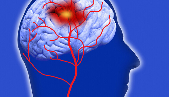 Врач назвала топ-3 показателя, которые влияют на риск инсульта