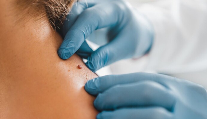 Как распознать опасную родинку: 5 признаков, на которые следует обратить внимание