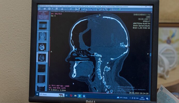 Справжнє диво: лікарі розповіли неймовірну історію дівчини, яка пережила ракетну атаку в Умані