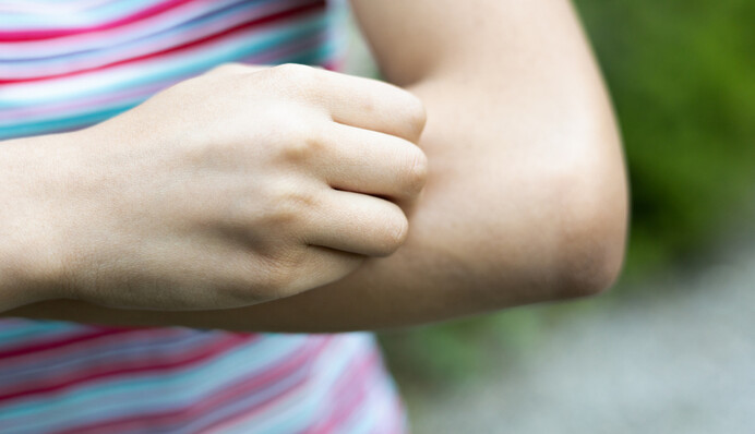 Як зменшити набряк, біль і зуд після укусу мошки: поради лікаря