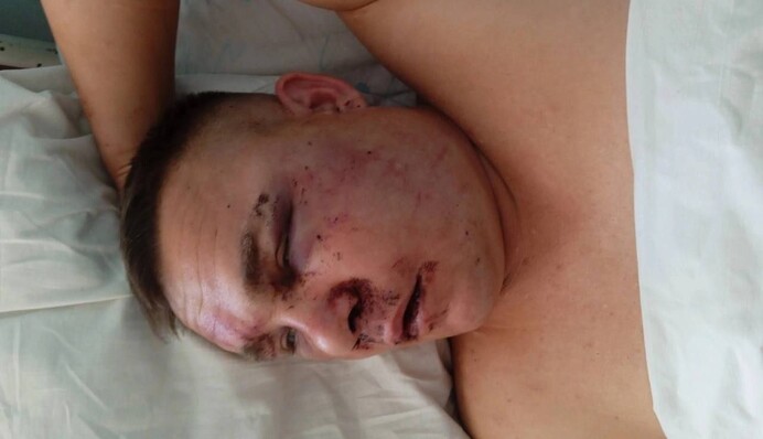 В Росії побили окупанта, який залишив в Україні ногу:  кричали 