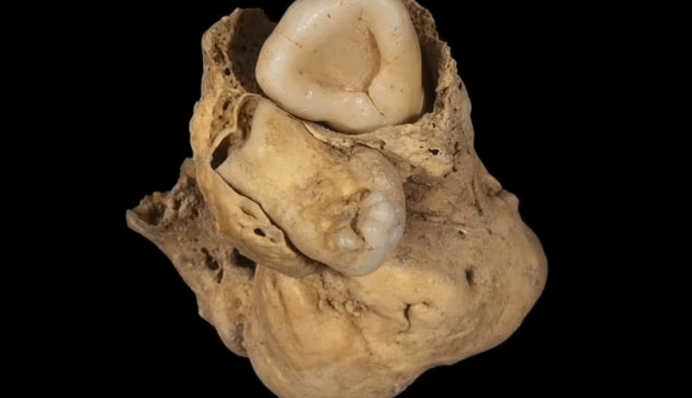 Моторошна знахідка: в гробниці знайшли пухлину яєчника з зубами, якій 3 тисячі років, фото