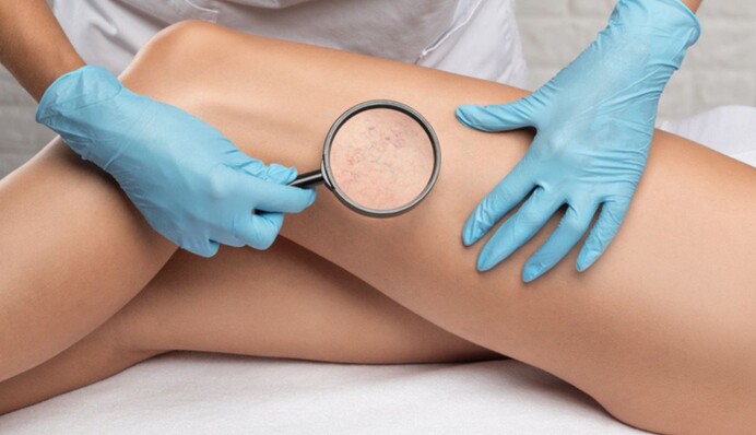 Варикоз дуже помолодів: лікар пояснив, чому виникає розширення вен