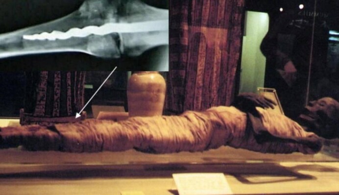 Ученые обнаружили штифт в колене мумии, не отличающийся от современных технологий. Видео