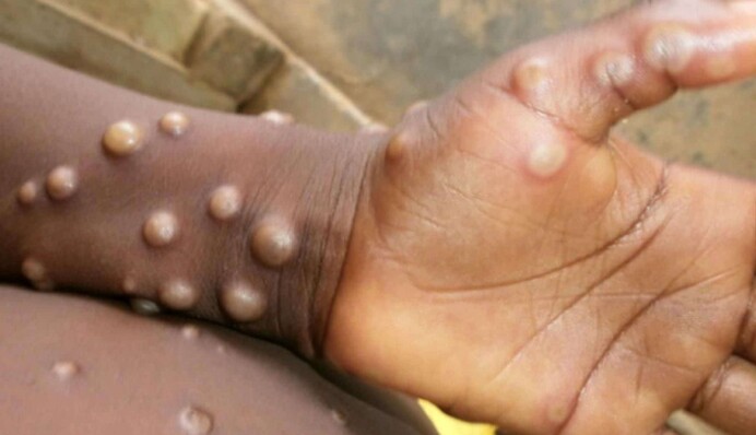 Новый смертельный вирус: в Африке за неделю зарегистрировали 1200 новых случаев обезьяньей оспы