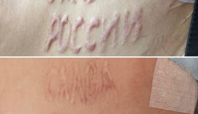 Медики показали результат лікування українського захисника,  якому російський лікар випалив на тілі напис “Слава Росії”