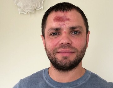 Пострадавший в ДТП российский музыкант опубликовал видео травм