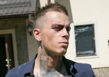 Опять драка: фанатов шокировало фото окровавленного участника 