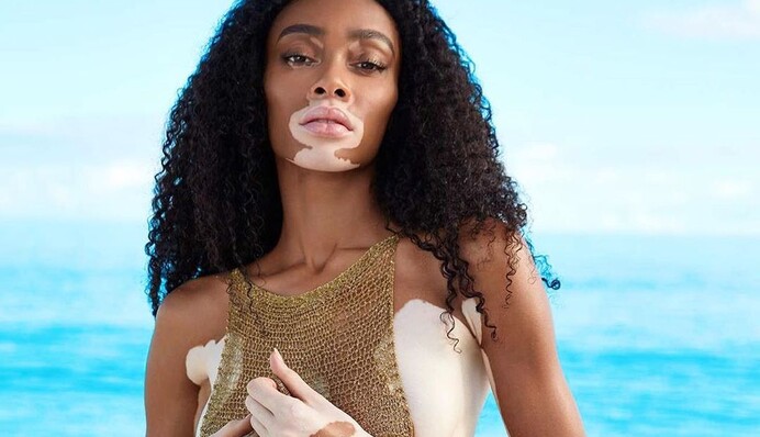 Знаменитая модель с редкой болезнью кожи впечатлила образом на красной дорожке в Каннах