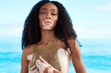 Знаменитая модель с редкой болезнью кожи впечатлила образом на красной дорожке в Каннах