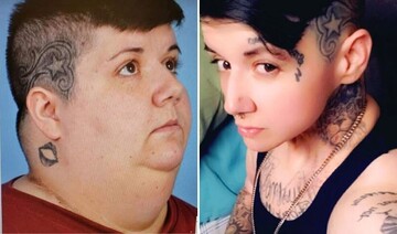 Жінка скинула 225 кг після видалення язика