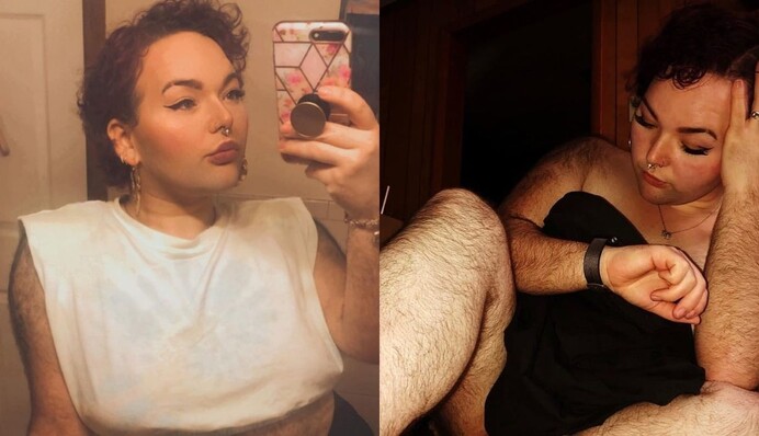 Все через рідкісну хворобу: дівчину прозвали Чубаккою через зайве волосся по всьому тілу