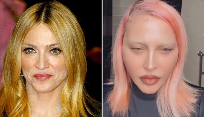 Пластические хирурги рассказали, из-за каких процедур Мадонна изменилась до неузнаваемости