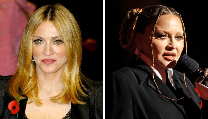 Набряк після операції спав: Мадонна показала, як змінилося її обличчя після пластики