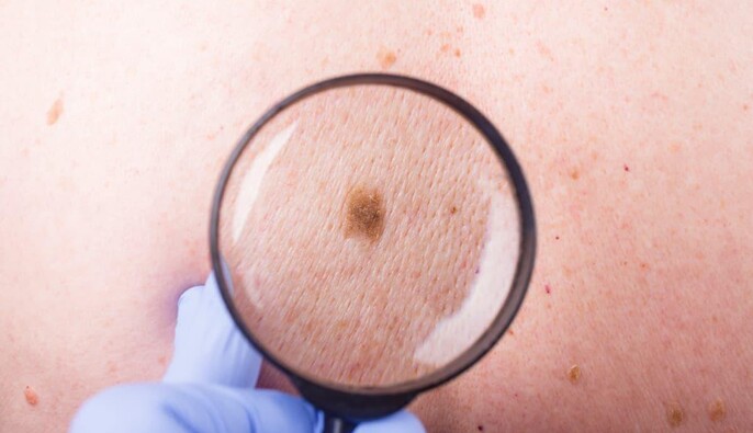 Украинская медицина получила первую партию иммунотерапии для лечения меланомы