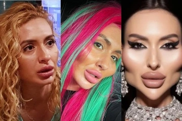 "Ничего не свисает": киевлянка с самыми большими скулами похвасталась поразительными изменениями лица