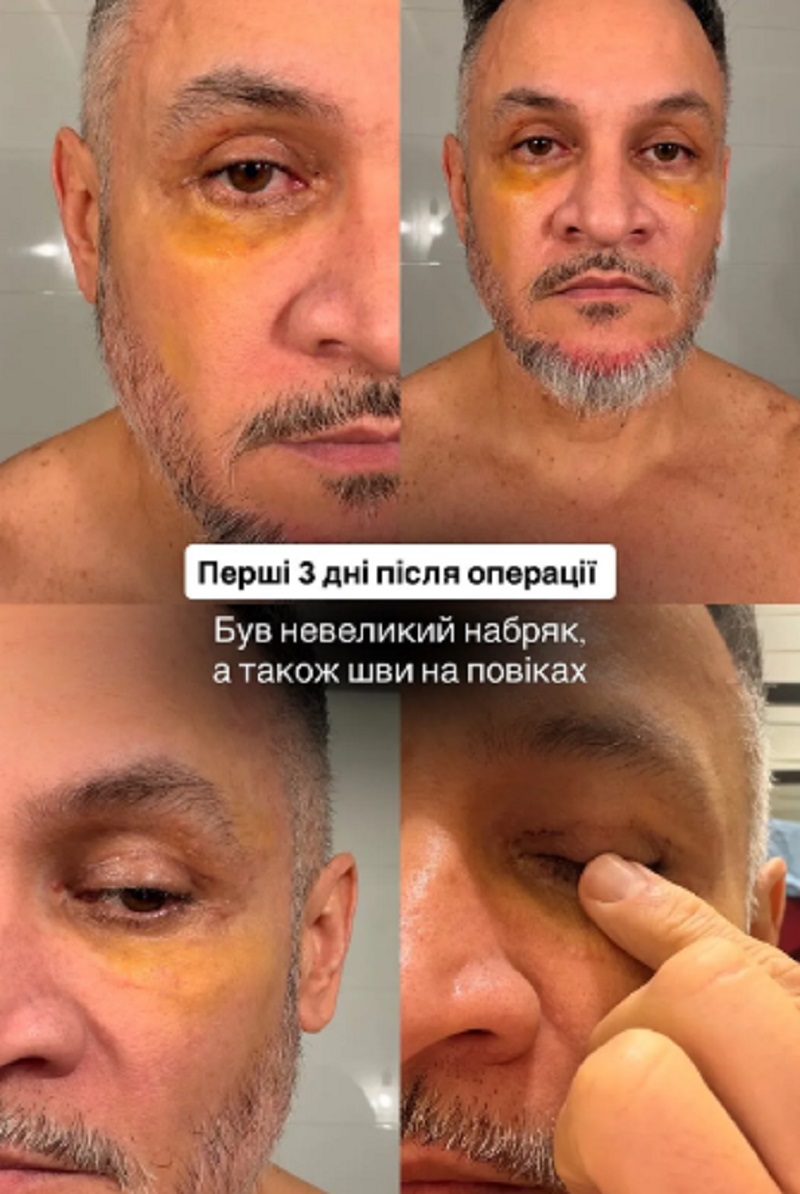 Первые дни после операции